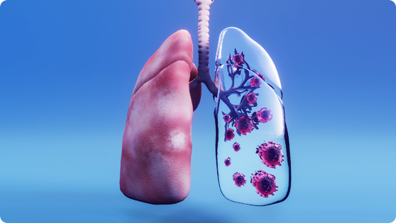 Pulmonology Treatments